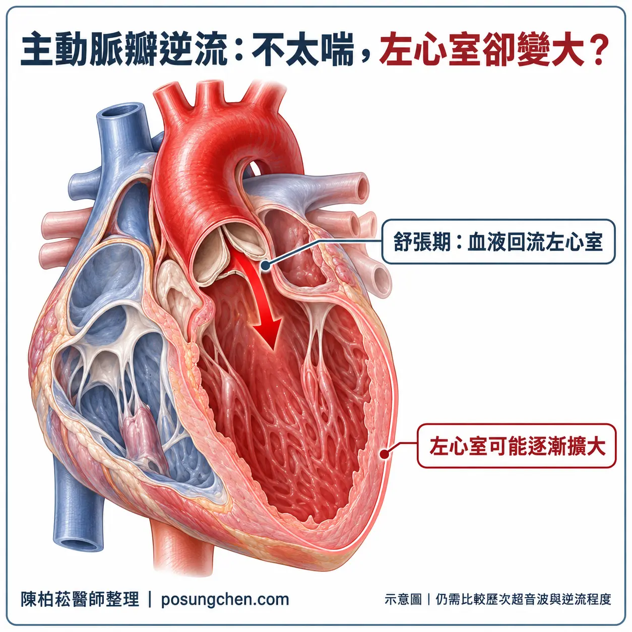 主動脈瓣逆流示意:舒張期血液由主動脈回流左心室,左心室可能逐漸擴大
