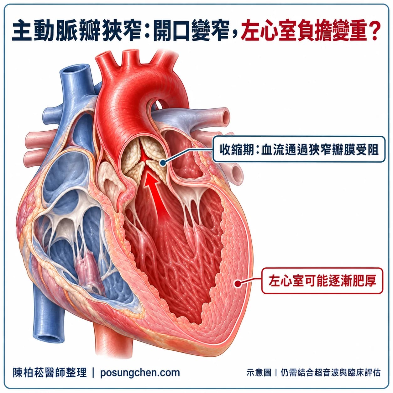 主動脈瓣狹窄:收縮期血液流出左心室受阻,長期可能造成左心室肥厚。