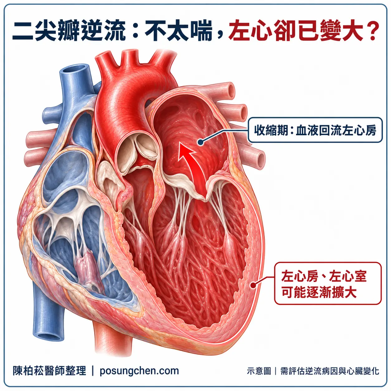 二尖瓣逆流示意:收縮期血液由左心室回流左心房,左心房與左心室可能逐漸擴大