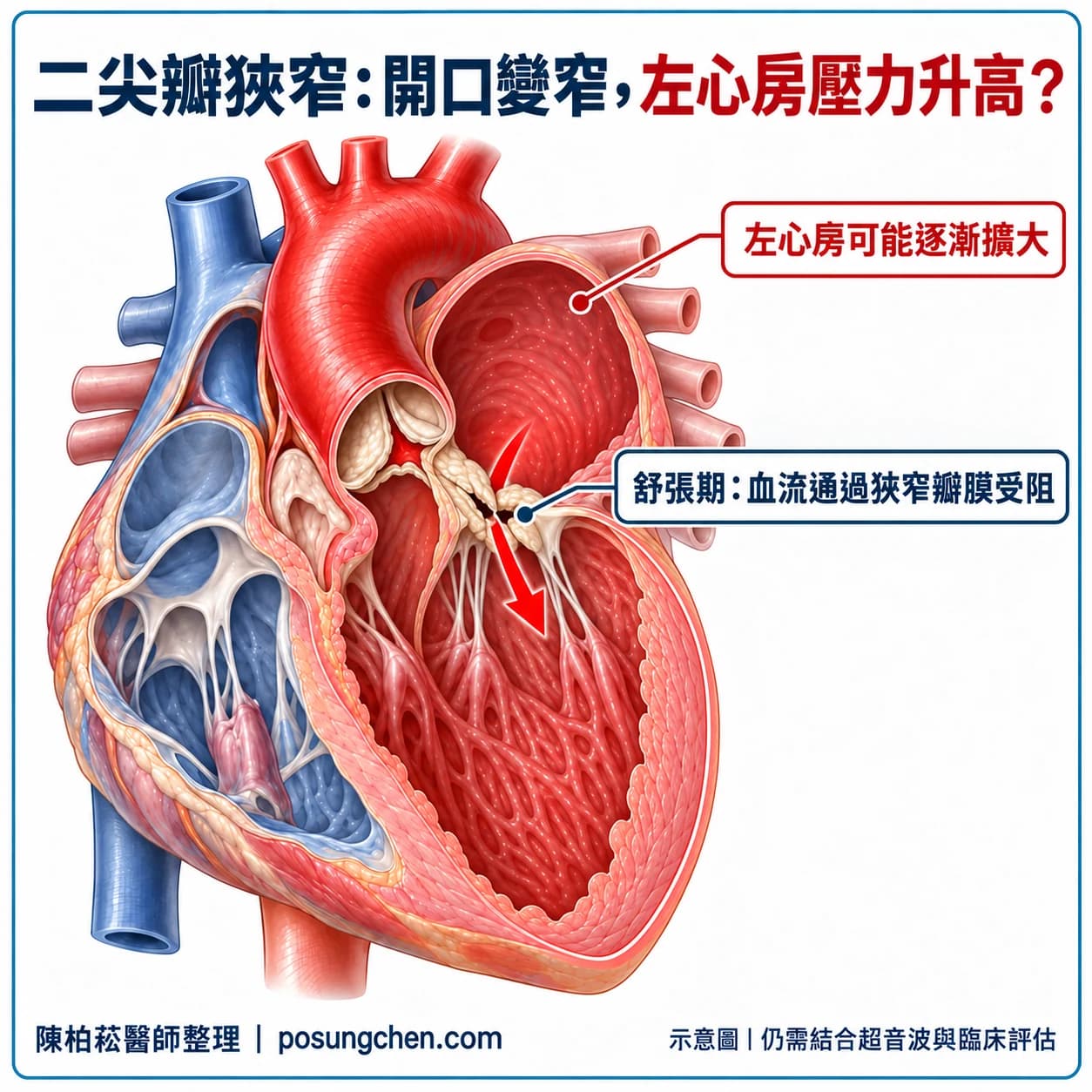 二尖瓣狹窄:舒張期左心房血液流入左心室受阻,左心房壓力可能上升並逐漸擴大。
