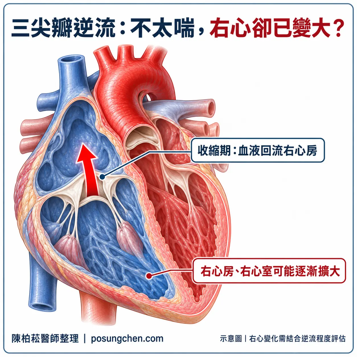 三尖瓣逆流示意:收縮期血液由右心室回流右心房,右心房與右心室可能逐漸擴大