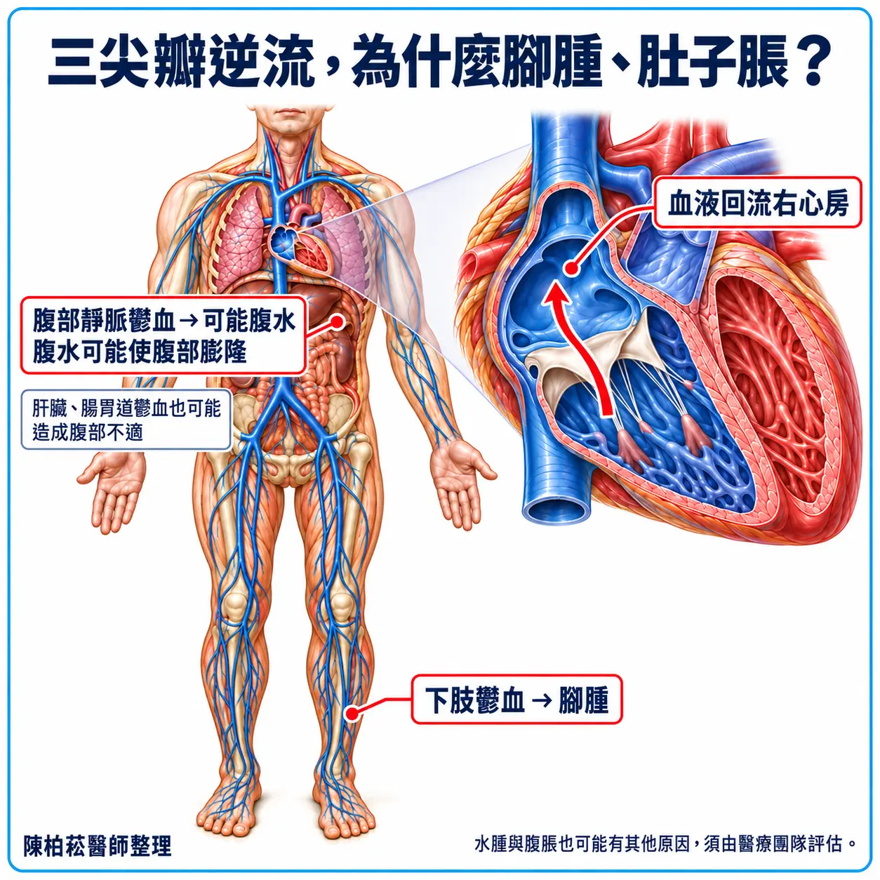 三尖瓣逆流時血液回流右心房,靜脈鬱血可能導致下肢水腫;腹部鬱血較嚴重時可能有腹水並使腹部膨隆