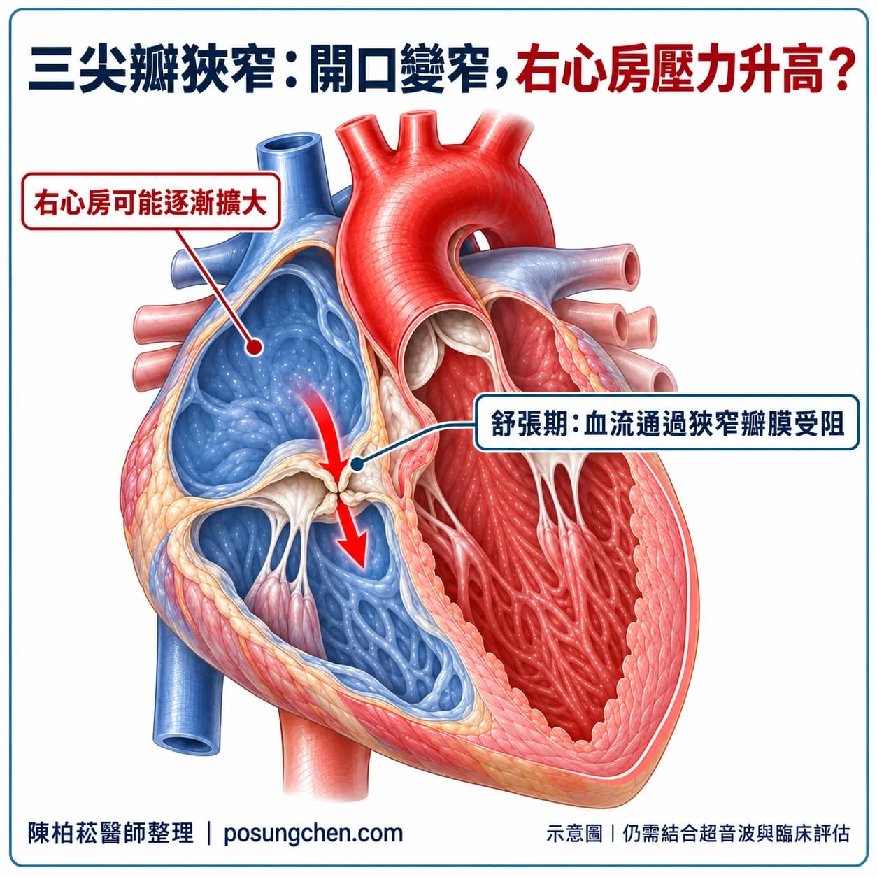 三尖瓣狹窄:舒張期右心房血液流入右心室受阻,右心房壓力可能升高。
