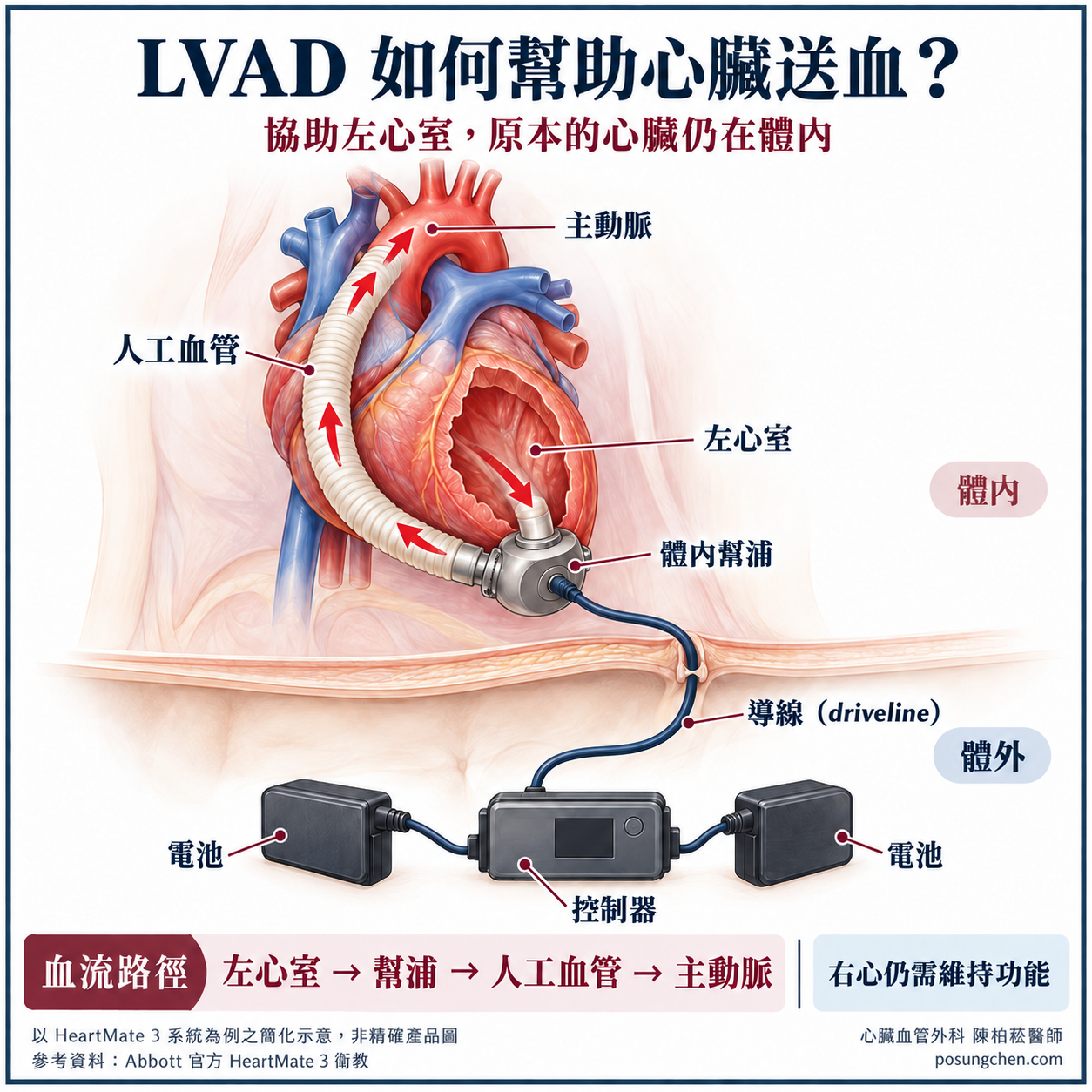 LVAD 體內幫浦、控制器與電池簡化示意圖