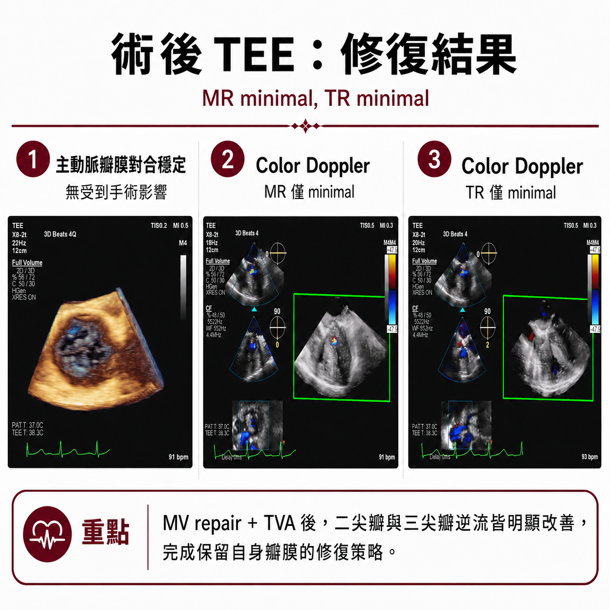 術後經食道心臟超音波:主動脈瓣膜對合穩定,二尖瓣逆流與三尖瓣逆流皆僅輕微